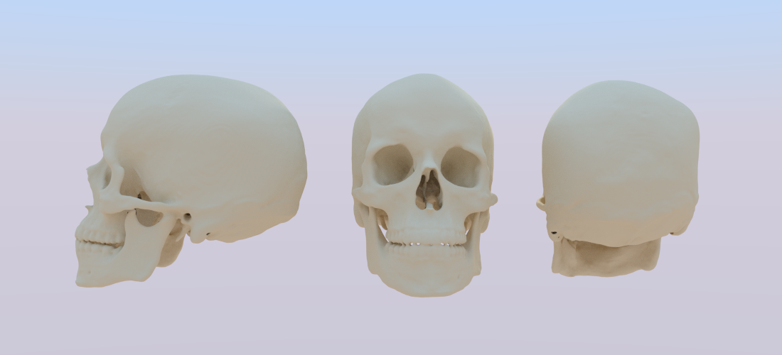 A Dicom Image of a skull